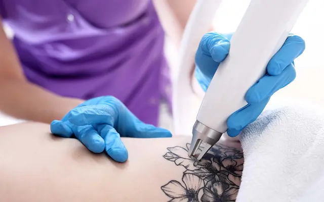 tattoo removal 3